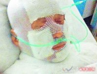 齊秦燒傷頭纏著紗布插著氧氣管錄音感謝歌迷 齊秦燒