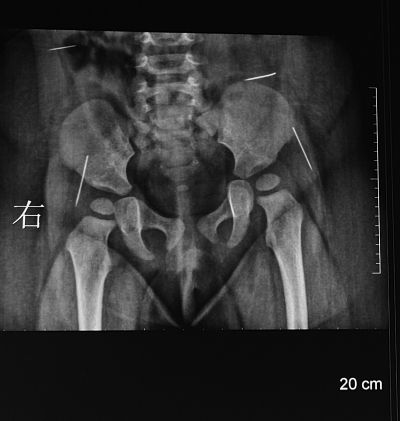 女嬰體內(nèi)4根繡花針