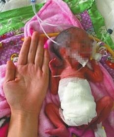 成都女嬰僅巴掌大