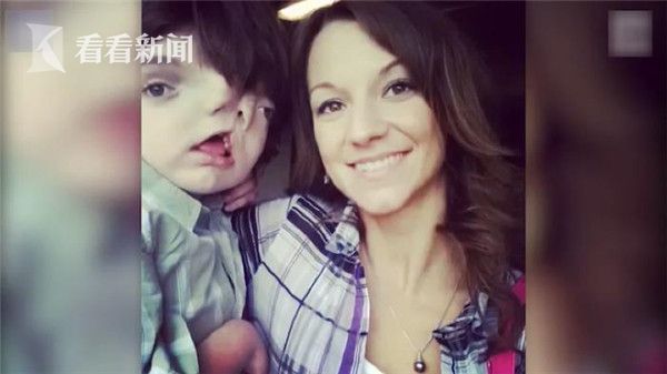 雙臉男孩13歲生日