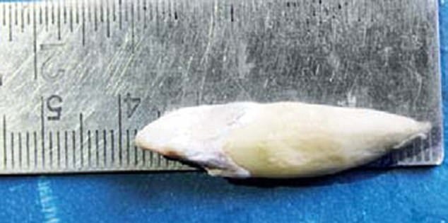 少年牙齒3.67厘米