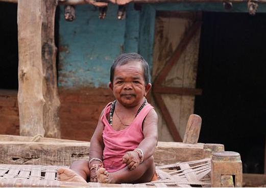 男子5歲停止生長