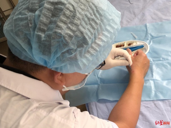 四川骨科大夫左手給右手做手術